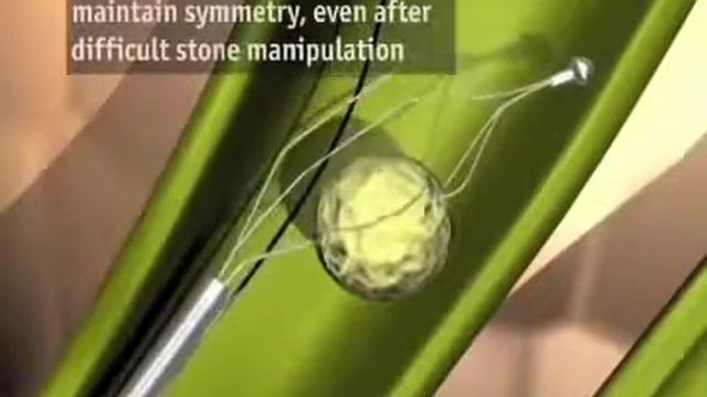 Эндоскопический механический контактный литотриптор Alliance 2