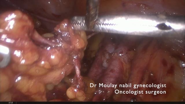 Pelvic lymphadenectomy ( right side) смотреть онлайн