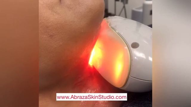 TITAN by Cutera Laser смотреть онлайн