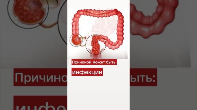 Причина повышения СОЭ в анализе крови смотреть онлайн