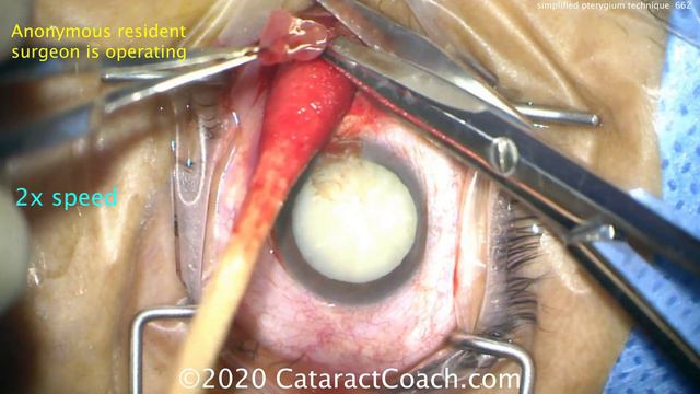 simplified technique for safe pterygium surgery смотреть онлайн