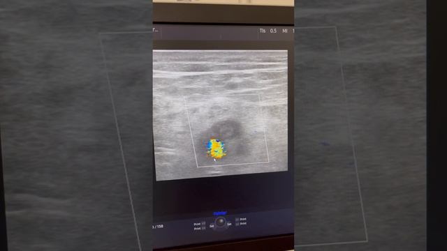 Тромбоз в подколенной вене. Лечение тромбоза. Флеболог Москва. Флеболог. Сосудистый хирург смотреть онлайн