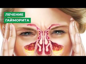 Лечение гайморита