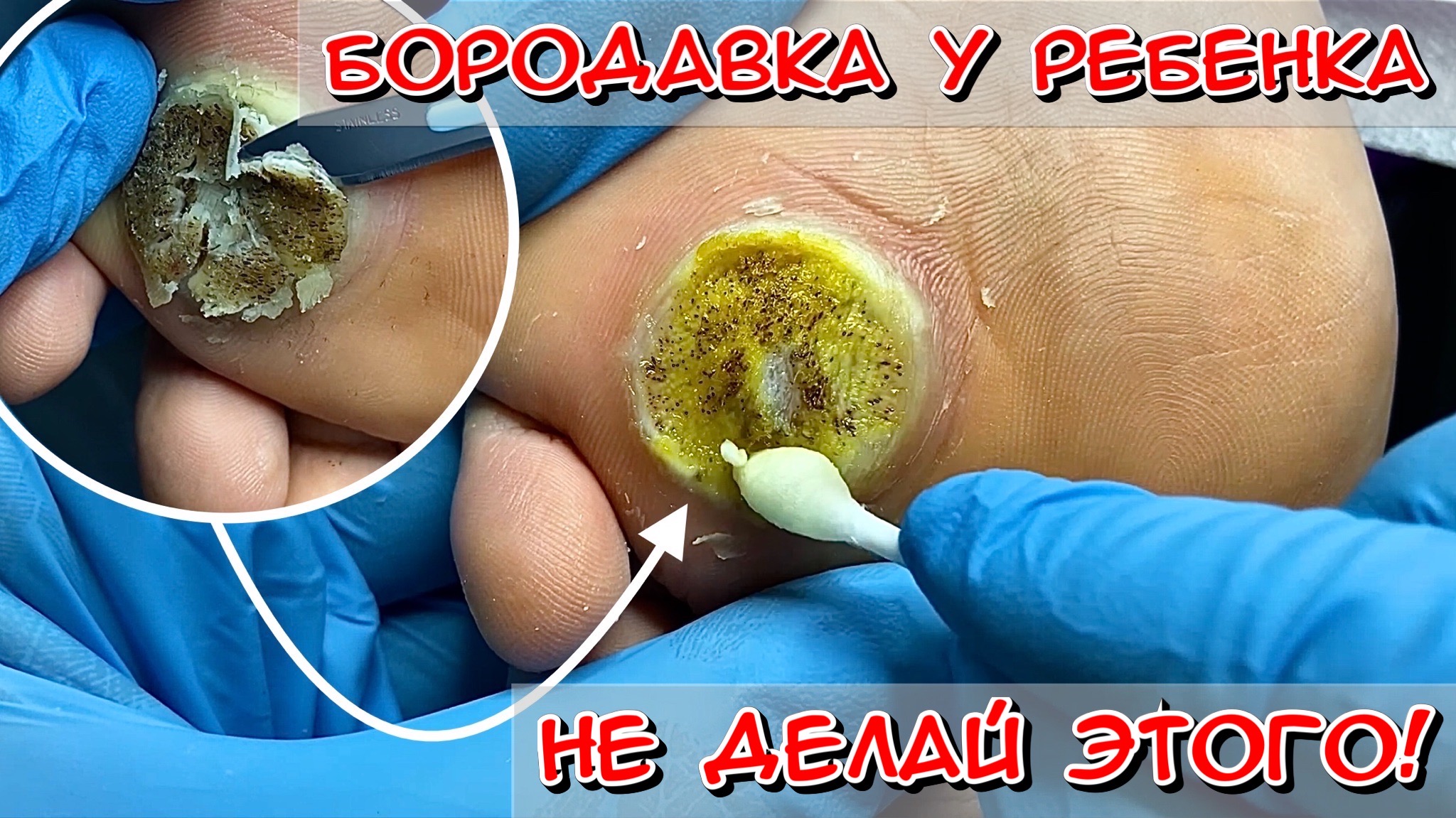 Бородавка у ребенка / не делай этого! смотреть онлайн