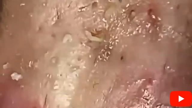No. 7 THE JUICIEST SELECTION OF PIMPLES AND BLACK SPOTS / БОЛЬШАЯ ПОДБОРКА КОВЫРЯНИЕ ЧЕРНЫХ ПРЫЩЕЙ смотреть онлайн