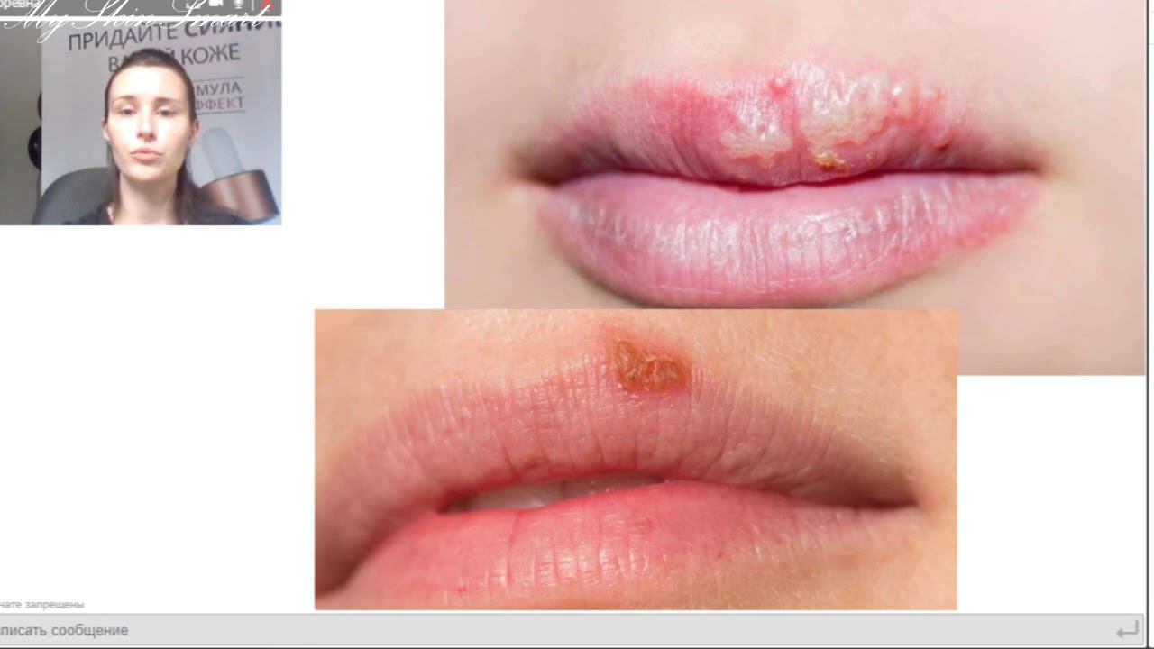 Лекция 9. Вирусные заболевания кожи. смотреть онлайн