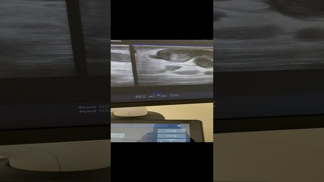 Тромбоз после неправильно проведённой операции. Узи сосудов. Флеболог Москва. Лечение тромбоза. УЗИ смотреть онлайн