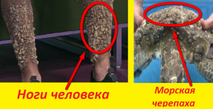К ногам человека присосались черепашьеичи паразиты