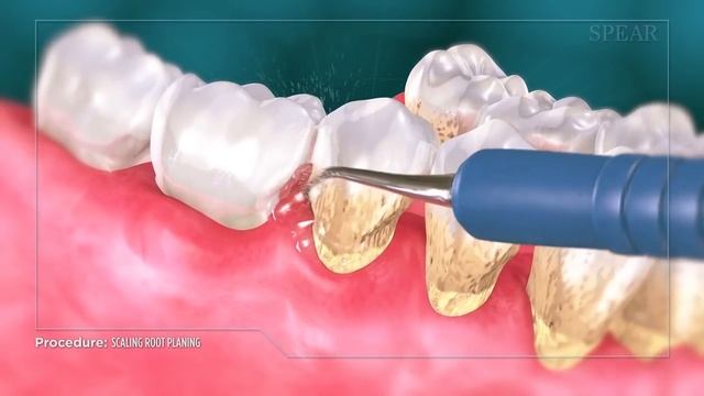 Scaling And Root Planing