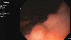 Подозрение на ранний рак желудка. Гастроскопия. ФГДС. Эндоскопия.