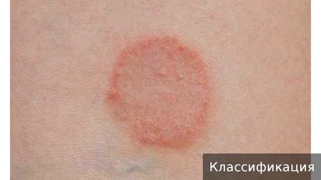 Гранулема кольцевидная. Как лечить гранулему кольцевидную. смотреть онлайн