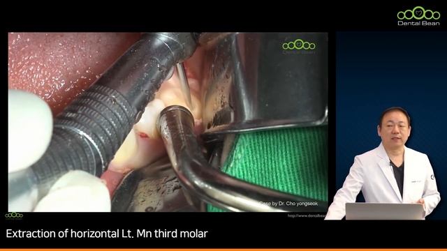 [MULTI_SUB] Extraction of horizontal Lt. Mn third molar - [Dr. Cho Yongseok] смотреть онлайн