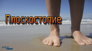 Плоскостопие