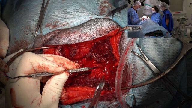 Люмбосакральный стеноз. Синдром кауда эквина. смотреть онлайн