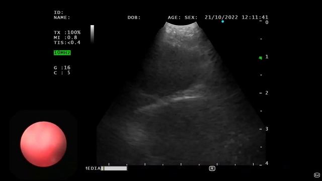 EBUS-TBCNB (EBUS guided cryo-biopsy from mediastinal lymph nodes) смотреть онлайн