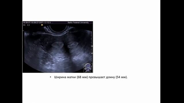 УЗИ органов малого таза у женщин: обзор видеопримеров смотреть онлайн