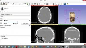 создание 3d-модели .stl для 3d-печати из данных КТ