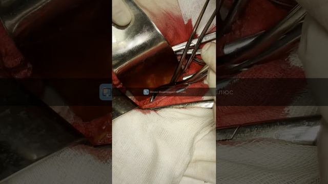 Холецистэктомия из мини-доступа у пациентки с диагнозом: ЖКБ. Хронический калькулезный холецистит. смотреть онлайн