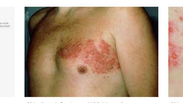 Aciclovir Part 2 смотреть онлайн