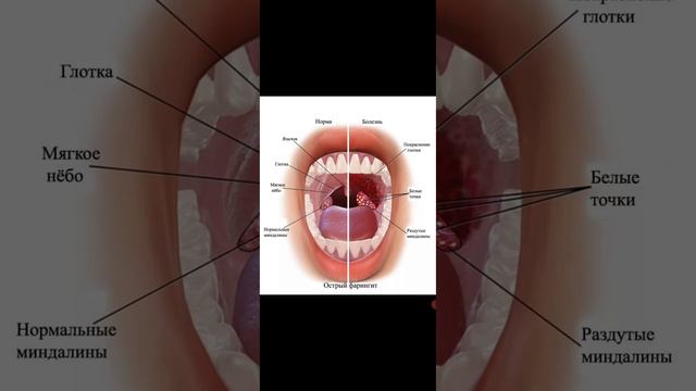 Надо ли удалять Гланды? смотреть онлайн