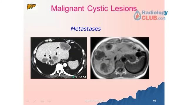 LIVER DISEASES - Imaging and Radiology - Subject Seminar Presentation смотреть онлайн