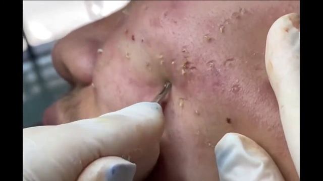 Remoção de cravo 2021 - Pimple Popping 2021- Blackhead Removal 010 смотреть онлайн
