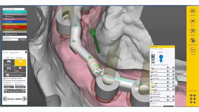 EXOCAD TUTORIALS - Software 2015 - Implantatsteg mit manueller Schraubkanalpositionierung Teil 2 смотреть онлайн