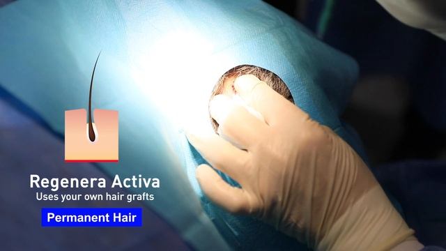 Regenera Activa Treatment | Hair Transplant | Dr. Emrah Cinik смотреть онлайн