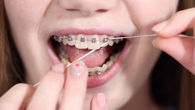 Как правильно чистить зубы нитью с брекетами? смотреть онлайн