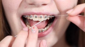 Как правильно чистить зубы нитью с брекетами?