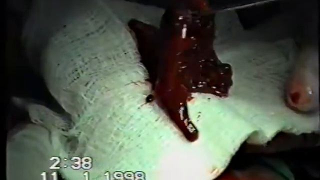 Огнестрельное сквозное ранение черепа с размозжением мозга смотреть онлайн