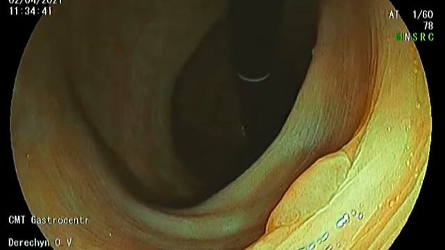 Колоноскопия в инверсии