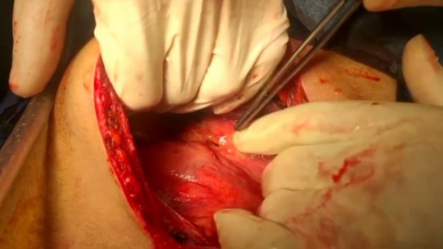 Perforated Gastric Ulcer..🔥🔥 смотреть онлайн