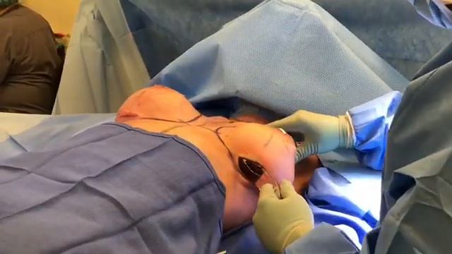Breast Implant Exchange - Breast Augmentation Redo at Azul Plastic Surgery Sugar Land Houston TX смотреть онлайн