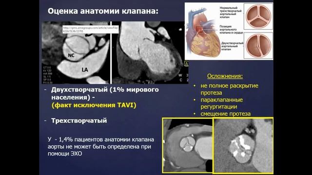 Басек И.В. «Роль МСКТ в планировании TAVI» смотреть онлайн