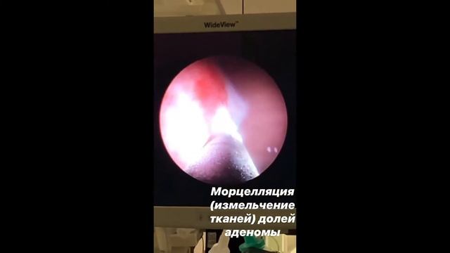 Лазерная (гольмиевая) энуклеация аденомы простаты смотреть онлайн