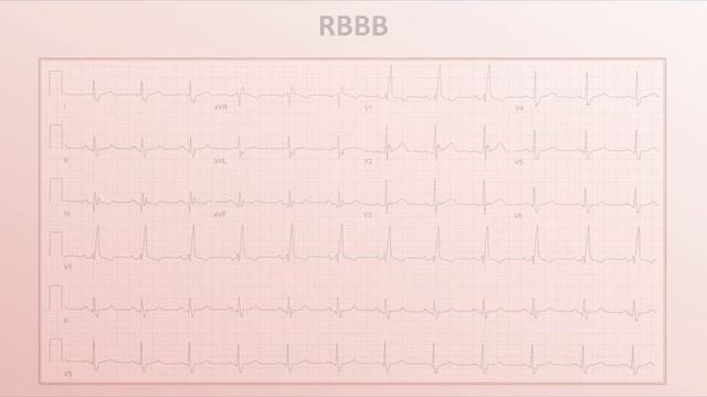 Intro to EKG Interpretation - Bundle Branch Blocks смотреть онлайн