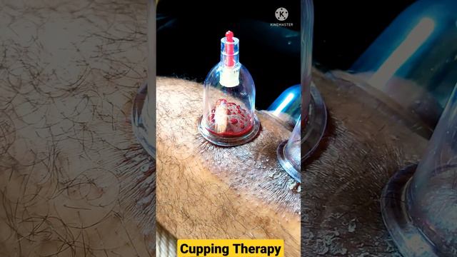 Cupping Therapy #short#रक्तमोक्षण#ayurveda