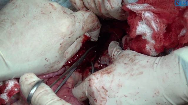 удаление надпочечника смотреть онлайн