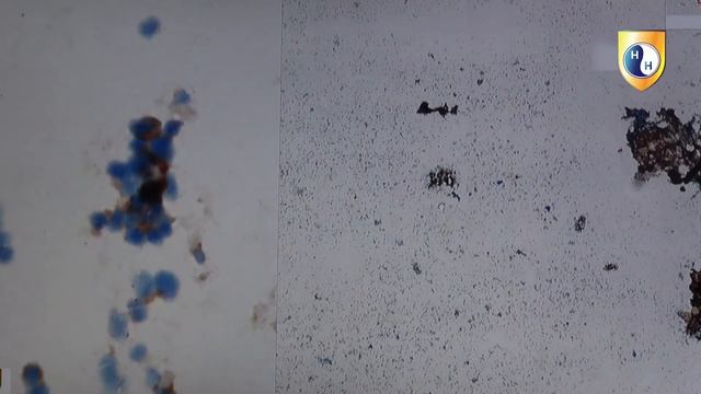 Метастаз уротелиальный. Цитологический практикум. смотреть онлайн