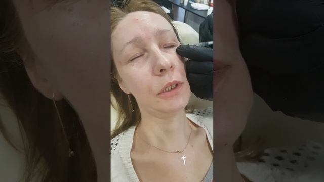 Убираем мимические морщины лба, возле глаз, межбровья и кроличьи морщины. смотреть онлайн