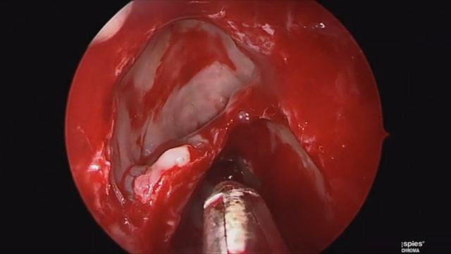 Functional Endoscopic Sinus Surgery (FESS) for Chronic Rhinosinusitis смотреть онлайн