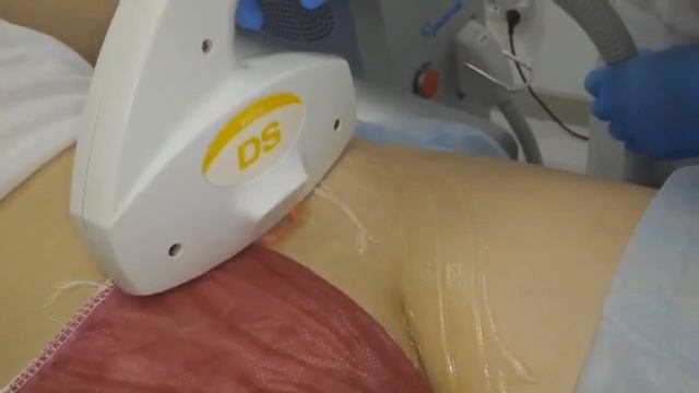 Элос эпиляция смотреть онлайн