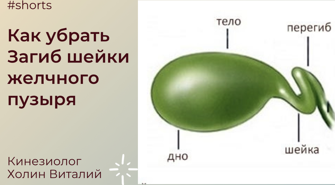 Как убрать Загиб шейки желчного пузыря смотреть онлайн