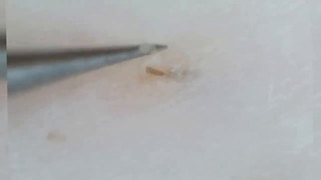 Removing Ingrown Hairs Hair