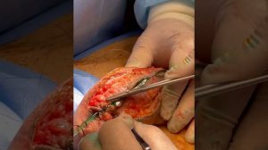 Протяженная реконструкция уретры местными тканями через год после фаллопластики.