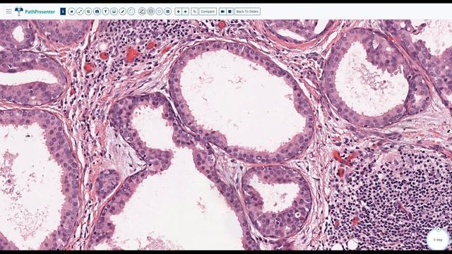 Salivary Gland Pathology II with Dr. Tranesh смотреть онлайн