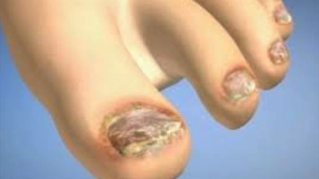 OYOQ TERLASHI VA GRIBOKNI ODDIY USULDA DAVOLASH