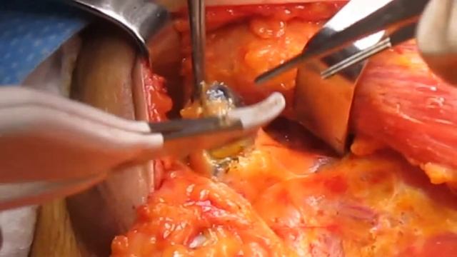 Sentinel Lymph Node Biopsy (SLNB) using LigaSure small jaw смотреть онлайн