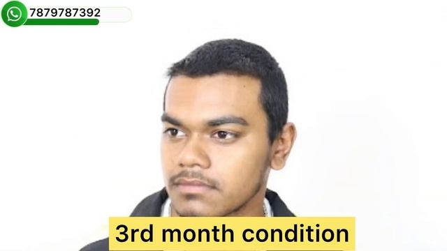 Case study- 6 month hair transplant result in low price//best hair transplant result in india смотреть онлайн